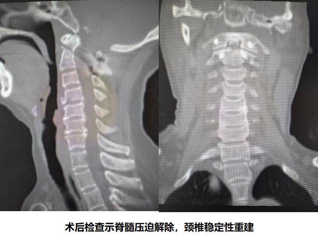 攻克“生命禁区”！长沙市中心医院成功救治寰枢椎脱位合并颈椎骨折危重患者