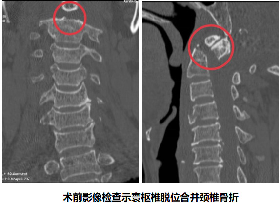 攻克“生命禁区”！长沙市中心医院成功救治寰枢椎脱位合并颈椎骨折危重患者