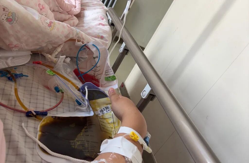 女子为减肥每天只吃1个素包子,饿了就喝水,7天瘦9斤,查出急性重症胆囊炎 医生:切忌长时间空腹