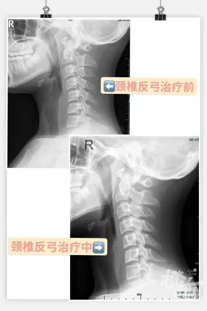 知名女演员自曝确诊!越来越多年轻人中招,严重或引起瘫痪……