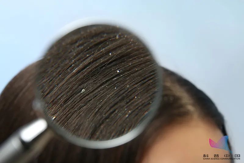 头皮屑多是因为清洁不到位？可能与这种疾病有关