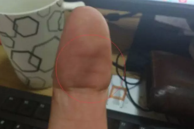 大拇指出现这种横纹，可能离中风不远了，快看你有没有？