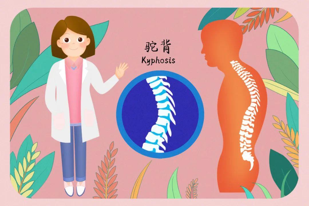 “网红神器”矫正驼背靠谱吗？一文了解→