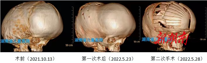 患上克鲁宗综合征,"外星宝宝"手术后重获新生