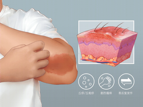 湿热来袭，预防湿疹